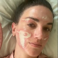 Niat Glow Up, Wanita Malah Alami Luka Bakar Permanen Usai Facial Mahal