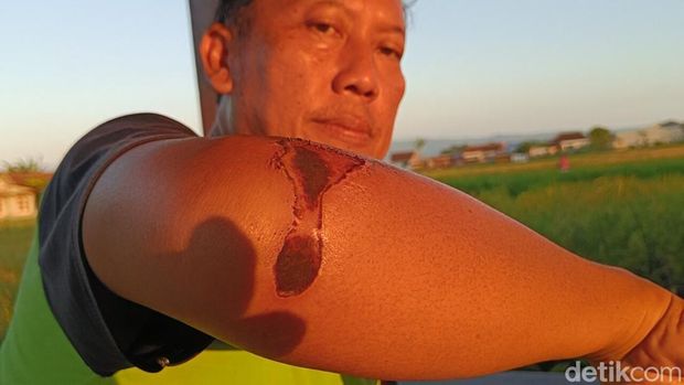 Kondisi tangan Arif yang terluka akibat mobil Kijang Panther terbuka muatan telur miliknya mengalami kecelakaan tunggal.
