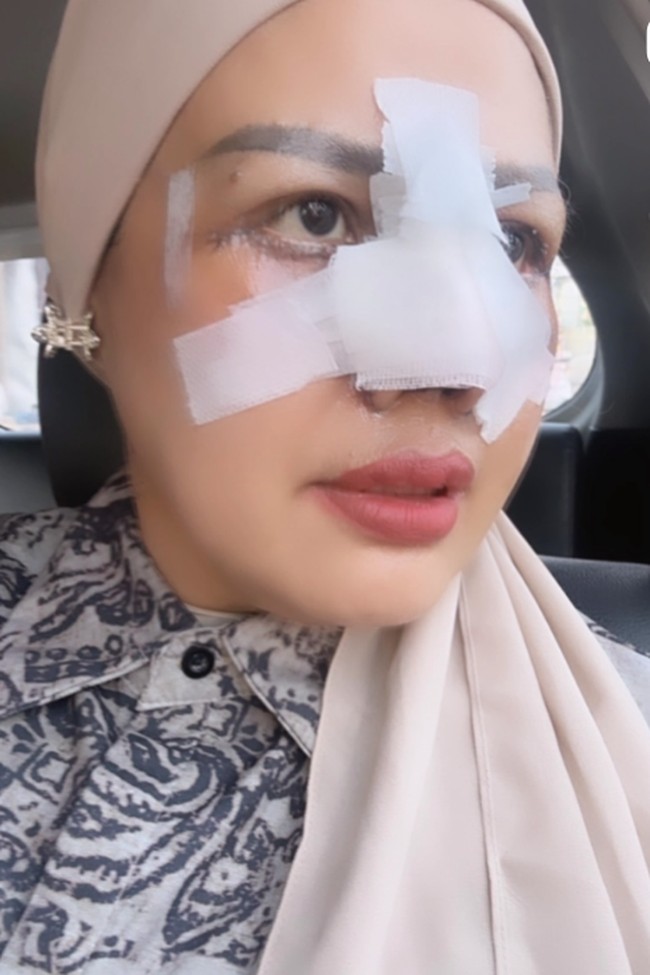 Melalui akun Instagram pribadinya Elly Sugigi membagikan perjalanan operasi plastik yang dilakukannya. Elly memilih melakukan operasi plastik di sebuah klinik kecantikan di Jakarta. Foto: Instagram/@ellysugigi_real