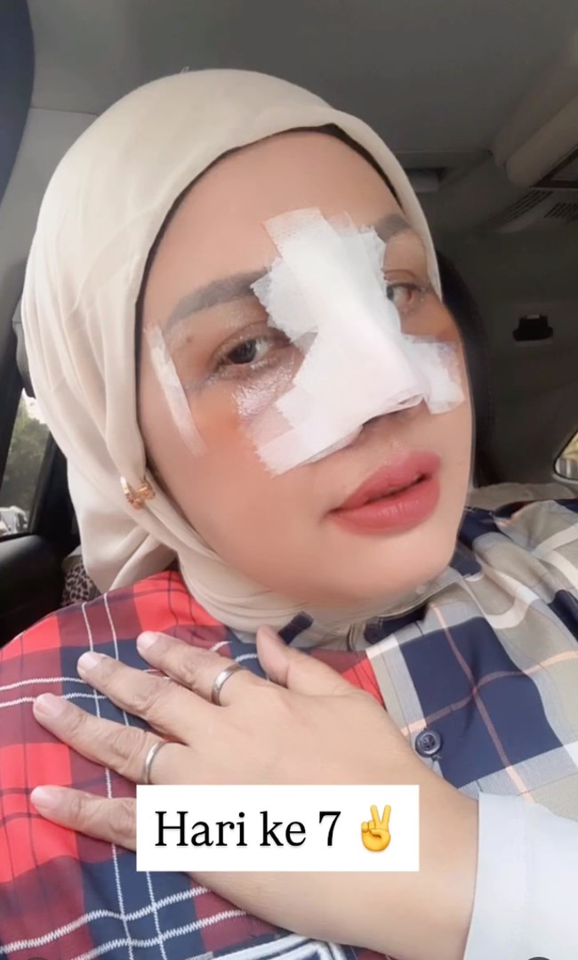 7 hari setelah menjalani operasi plastik terlihat wajah Elly yang masih bengkak. Bagian hidungnya juga masih full perban. Foto: Instagram/@ellysugigi_real