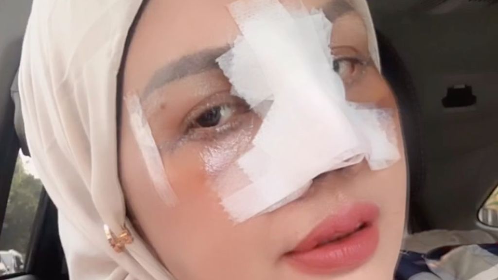 Tak Puas Oplas Hidung dan Mata, Elly Sugigi Incar Permak Gigi dan Facelift