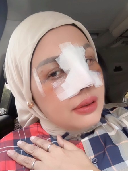 Potret Terbaru Elly Sugigi Setelah Oplas, Kini Berhidung Mancung