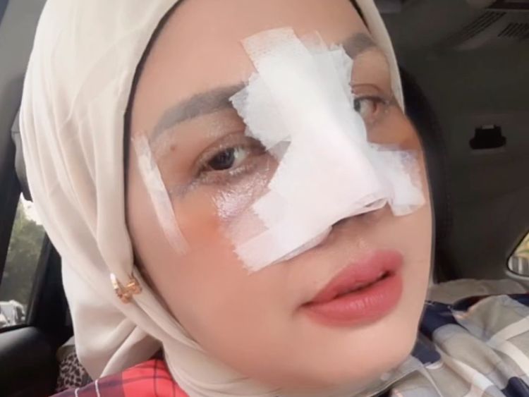 Potret Terbaru Elly Sugigi Setelah Oplas, Kini Berhidung Mancung