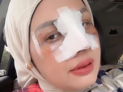 Potret Terbaru Elly Sugigi Setelah Oplas, Kini Berhidung Mancung