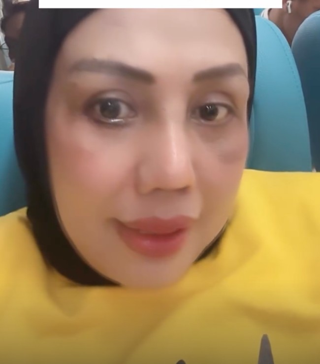 Setelah oplas hidung, Elly mengaku banyak netizen memintanya untuk juga merapikan bagian giginya. Aku orang yang selalu bersykur apa yang Allah berikan pada aku ..mohon maaf aku op idung hanya untuk perbaiki diri..bukan jual ..sekarang bqnyqk komen pada gigi ku di benerin juga .. tulis Elly dalam salah satu keterangan unggahannya. Foto: Instagram/@ellysugigi_real