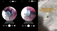 Sering Migrain, Wanita Ini Syok Temukan Benda Asing Dekat Gendang Telinga