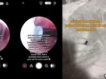 Sering Migrain, Wanita Ini Syok Temukan Benda Asing Dekat Gendang Telinga