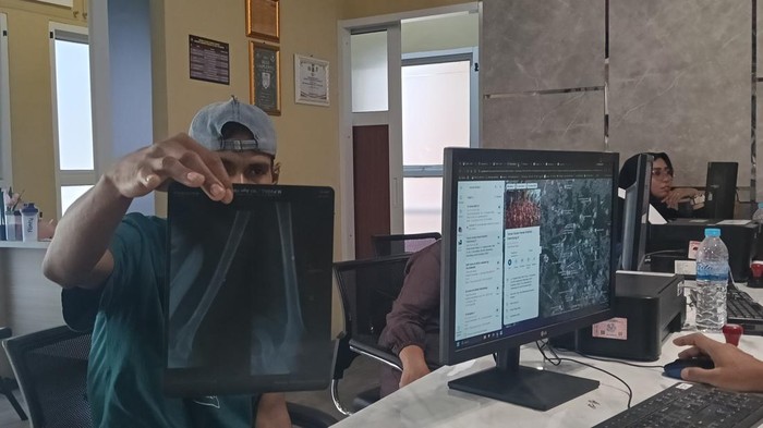Korban Padli saat melapor ke Polrestabes Palembang sambil menunjukkan hasil Rontgen di pahanya