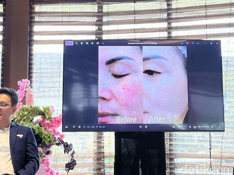 Acara Melasma Awareness Month, bersama PT Unison Medika Jaya,  dr. Stanley Setiawan, dan  dr. Ratna Yuliarviana.