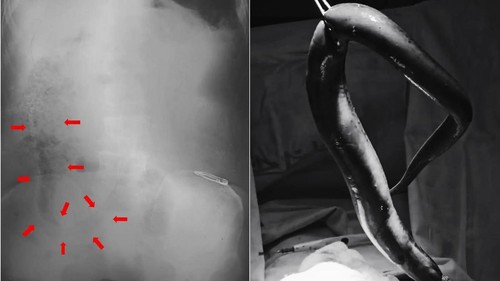 Dokter Sampai Syok! Belut 65 Cm Ditemukan Masih Hidup di Usus Pria Ini