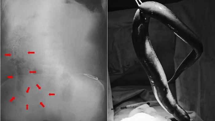Dokter Sampai Syok! Belut 65 Cm Ditemukan Masih Hidup di Usus Pria Ini