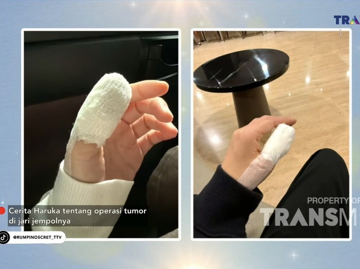 Haruka operasi ibu jari karena tumor