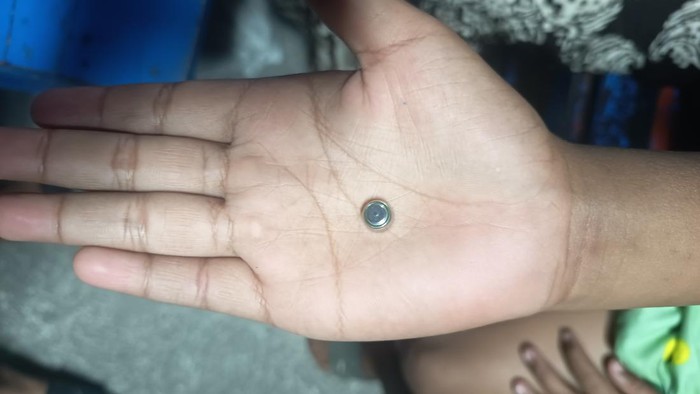 Proses evakuasi baterai jam tangan dari telinga bocah di Tasikmalaya.