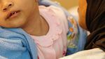 Operasi Bibir Sumbing Gratis Hadirkan Senyum Baru bagi Anak-anak