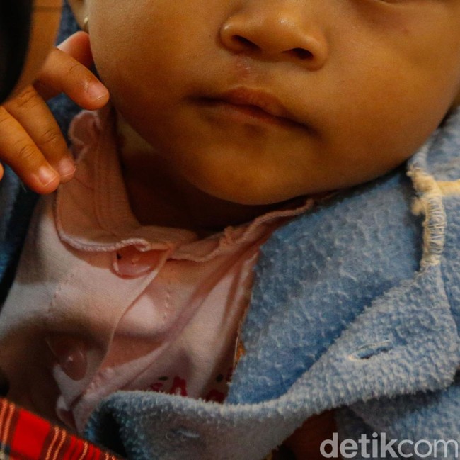 Operasi Bibir Sumbing Gratis Hadirkan Senyum Baru bagi Anak-anak