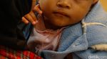 Operasi Bibir Sumbing Gratis Hadirkan Senyum Baru bagi Anak-anak