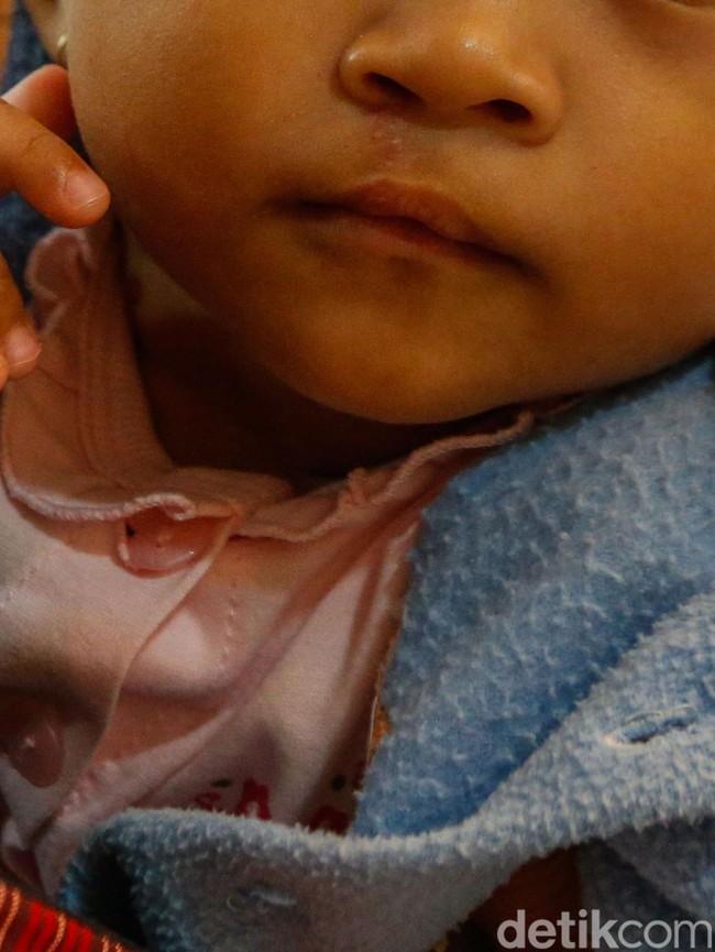 Operasi Bibir Sumbing Gratis Hadirkan Senyum Baru bagi Anak-anak