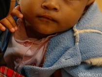 Operasi Bibir Sumbing Gratis Hadirkan Senyum Baru bagi Anak-anak