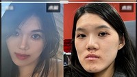 Operasi Rahang Berujung Petaka, Wajah Wanita Ini Malah Jadi Berubah Drastis