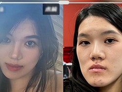 Operasi Rahang Berujung Petaka, Wajah Wanita Ini Malah Jadi Berubah Drastis