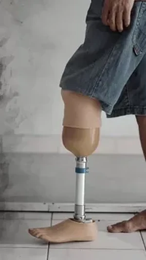 Kaki Palsu untuk Osi Agar Bisa Beraktivitas di Sekolah