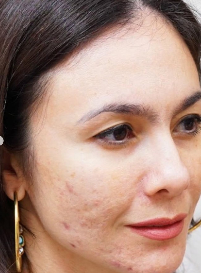Jauh berbeda dengan saat ini, tampak jelas dulu kulit wajah Wulan memiliki banyak noda dan bekas jerawat.  Foto: Instagram/@wulanguritno