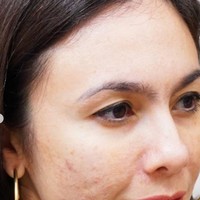 Jauh berbeda dengan saat ini, tampak jelas dulu kulit wajah Wulan memiliki banyak noda dan bekas jerawat.  Foto: Instagram/@wulanguritno