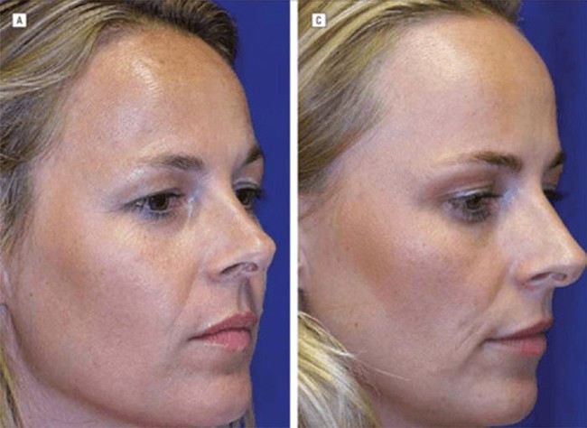 Studi ini mengungkapkan bahwa Botox rutin bisa ‘melatih’ otot wajah. Seiring bertahun-tahun perawatan, wanita kembar yang menggunakan Botox secara alami terbiasa mengurangi gerakan mengekspresikan wajah secara berlebihan, sehingga kerutan baru enggan terbentuk bahkan saat efek obatnya habis. Foto: Dok. Semantic Schola