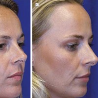 Studi ini mengungkapkan bahwa Botox rutin bisa ‘melatih’ otot wajah. Seiring bertahun-tahun perawatan, wanita kembar yang menggunakan Botox secara alami terbiasa mengurangi gerakan mengekspresikan wajah secara berlebihan, sehingga kerutan baru enggan terbentuk bahkan saat efek obatnya habis. Foto: Dok. Semantic Schola