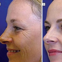 Viral! Foto Beda Wajah Kembar Identik: 20 Tahun Pakai Botox Vs Tidak