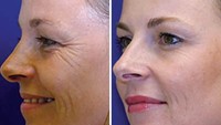 Viral! Foto Beda Wajah Kembar Identik: 20 Tahun Pakai Botox Vs Tidak