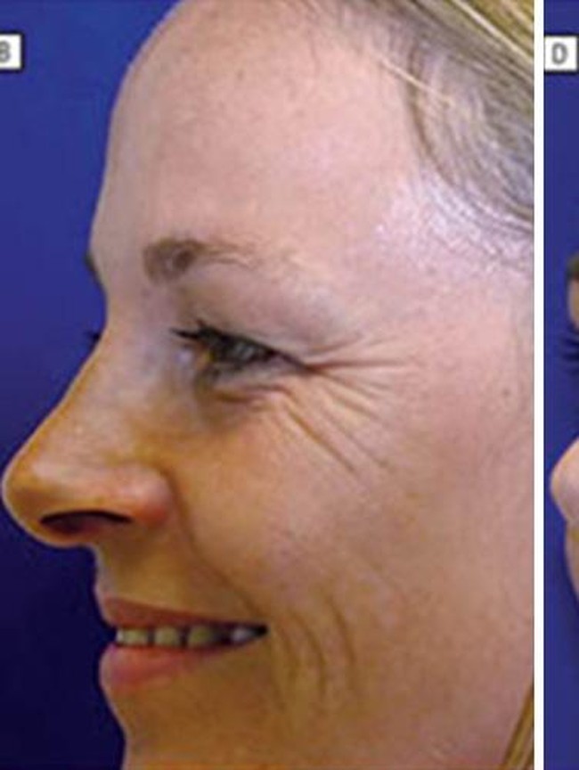 Viral! Foto Beda Wajah Kembar Identik: 20 Tahun Pakai Botox Vs Tidak