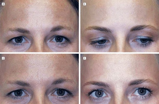 Perbedaan tekstur dan kerutan halus hanya terlihat di area yang disuntik. Sementara pada area yang tidak disuntik seperti garis senyum, kedua wanita kembar ini mengalami penuaan dengan laju yang persis sama. Penelitian ini membuktikan Botox tidak menghentikan penuaan secara total. Foto: Dok. Semantic Schola