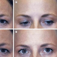 Perbedaan tekstur dan kerutan halus hanya terlihat di area yang disuntik. Sementara pada area yang tidak disuntik seperti garis senyum, kedua wanita kembar ini mengalami penuaan dengan laju yang persis sama. Penelitian ini membuktikan Botox tidak menghentikan penuaan secara total. Foto: Dok. Semantic Schola