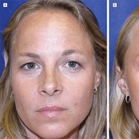 Setelah 13 hingga 20 tahun pengamatan, perbedaan paling mencolok terlihat saat wajah dalam posisi rileks. Wanita yang rutin melakukan Botox hampir tidak memiliki garis permanen di dahi, sementara kembarannya yang menua alami tampak memiliki kerutan statis di area tersebut. Menariknya, wanita kembar yang rutin memakai Botox tidak membutuhkan dosis yang terus membesar atau bertambah dari tahun ke tahun untuk menjaga kulitnya tetap mulus. Ia tetap mempertahankan jadwal perawatan kulitnya yaitu hanya 2 hingga 3 kali suntik Botox dalam setahun. Foto: Dok. Semantic Schola
