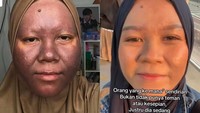 Sempat Menggelap Gegara Krim Merkuri, Kulit Wanita Ini Kini Kembali Sehat
