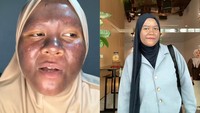 Awal Mula Kulit Wanita Ini Menggelap Gegara Krim Merkuri, Kini Berangsur Pulih
