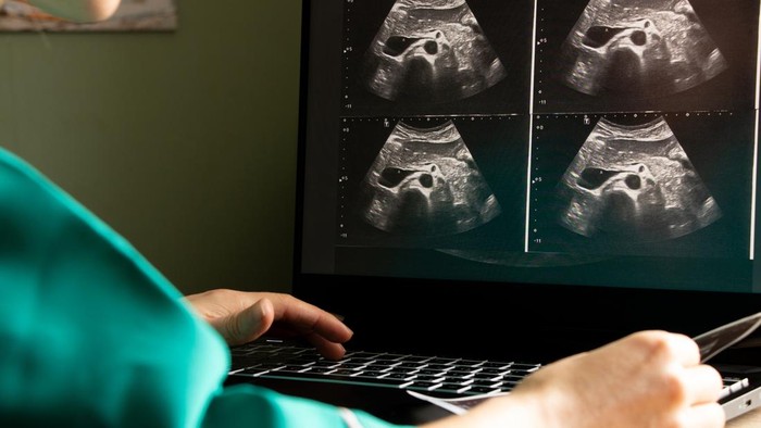 Ultrasound of a womans abdomen on a laptop screen monitor in a doctors office, diagnostics of an abdominal pain, medicine