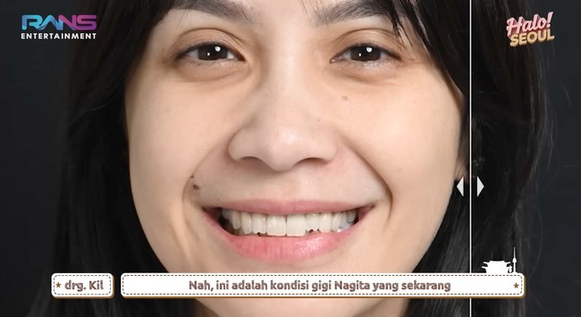 Nagita pun membagikan foto giginya sebelum pemasangan veneer. Istri Raffi Ahmad itu mengungkapkan jika ini adalah kali pertamanya menjajal veneer. Foto: YouTube/Rans Entertainment