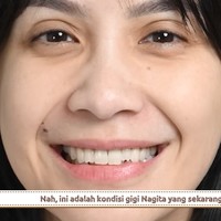 Nagita pun membagikan foto giginya sebelum pemasangan veneer. Istri Raffi Ahmad itu mengungkapkan jika ini adalah kali pertamanya menjajal veneer. Foto: YouTube/Rans Entertainment
