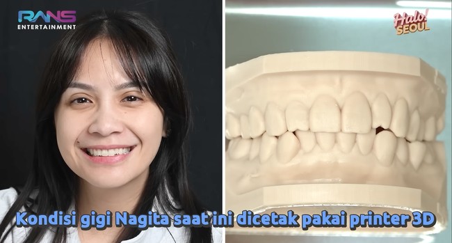 Sebelum tindakan, bentuk gigi Nagita juga dicetak terlebih dahulu menggunakan printer 3D. Foto: YouTube/Rans Entertainment