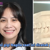 Sebelum tindakan, bentuk gigi Nagita juga dicetak terlebih dahulu menggunakan printer 3D. Foto: YouTube/Rans Entertainment