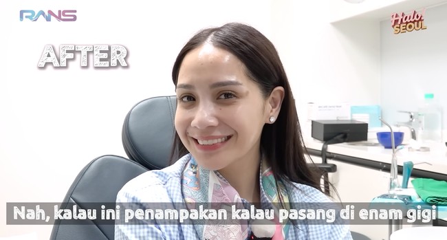 Hasil setelah pemasangan veneer selesai. Nagita diketahui memasang 6 veneer pada bagian gigi atasnya. Di awal pemasangan ia mengaku masih merasa aneh dan merasa seperti ada yang mengganjal. Foto: YouTube/Rans Entertainment