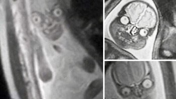 Ketika perempuan hamil menjalani pemeriksaan MRI. Fetusnya terlihat seperti ini. Foto: vikrogers via Bored Panda