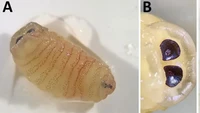 Merinding! Ada 10 Larva Bersarang di Hidung Wanita Ini