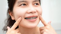 Kenapa Pemakai Behel Sering 'Iyup'? Dokter Gigi Ungkap Penyebab dan Cara Mengatasi