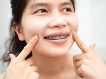 Kenapa Pemakai Behel Sering Iyup? Dokter Gigi Ungkap Penyebab dan Cara Mengatasi