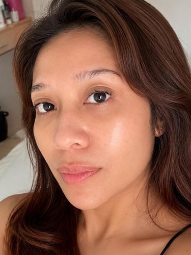 Hasil derma boostox setelah lima hari Hasil derma boostox setelah lima hari