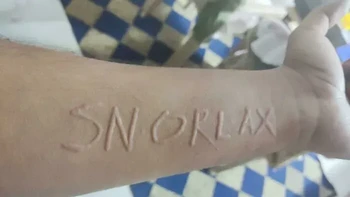 Kondisi ini disebut dermatografia. Sedikit goresan pada kulit dapat memicu munculnya garis merah yang menonjol mengikuti pola garukan, sehingga kulit terlihat seperti bisa ditulisi. Foto: via Boredpanda
