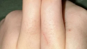 Ibu jari pada tangan ini tidak dapat menekuk seperti biasanya karena tidak memiliki sendi pada bagian yang seharusnya memungkinkan gerakan tersebut. Foto: via Boredpanda